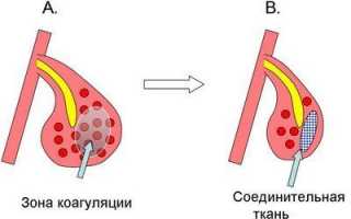 Помогает ли дыхательная гимнастика при насморке? Эффективные комплексы упражнений