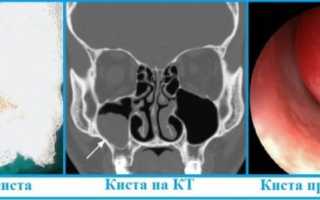 Цвет соплей – что значит, о какой болезни говорит
