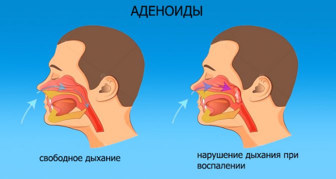 Инфекционная болезнь