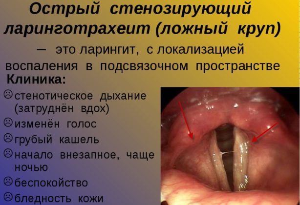 Ларинготрахеит