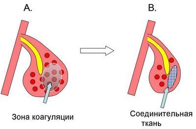 методический материал по вазомоторному риниту