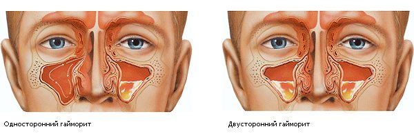 народные средства от гайморита у взрослых с хозяйственным мылом