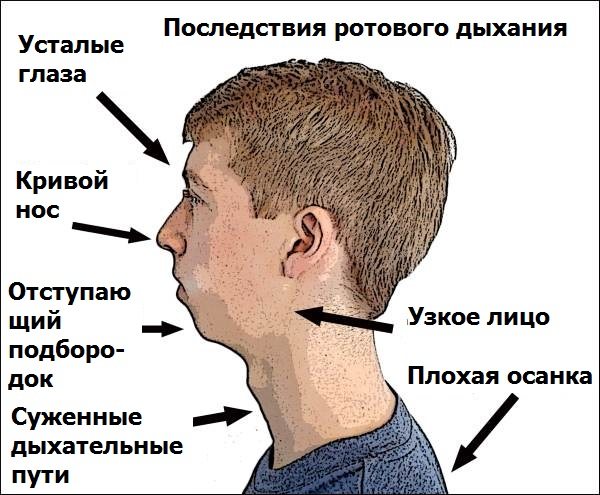 Последствия ротового дыхания