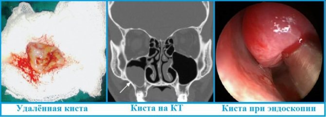 Причины возникновения желтых соплей это киста носовой пазухи