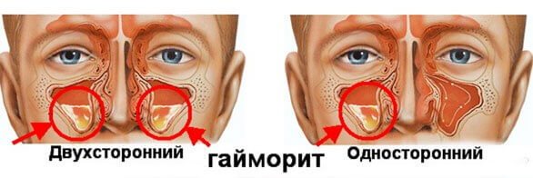Применение препарата флуимуцил - антибиотик ит в ингаляционной терапии респираторных инфекции