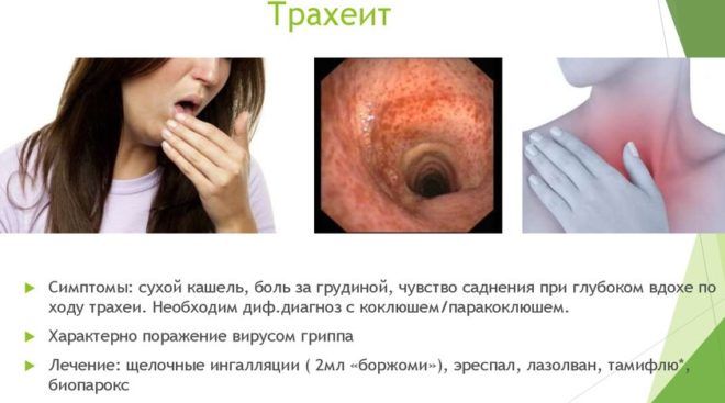 Трахеит