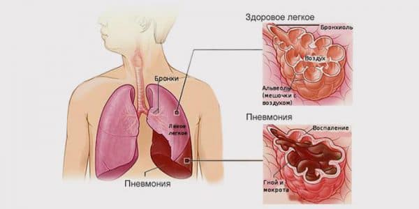 Воспаление легких (пневмония) как осложнение трахеита
