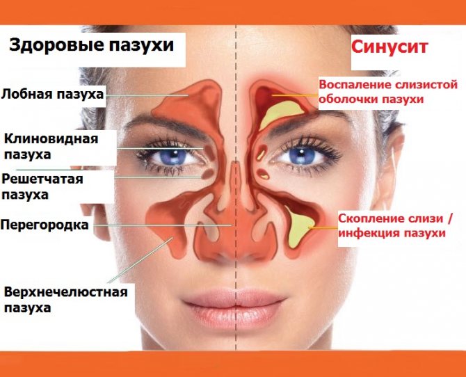 Воспаление пазух