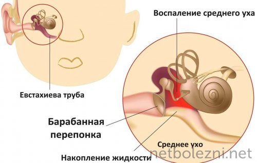 Воспаление среднего уха